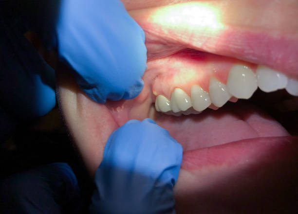 Best Emergency Care for Gum Disease in Florham Park, NJ